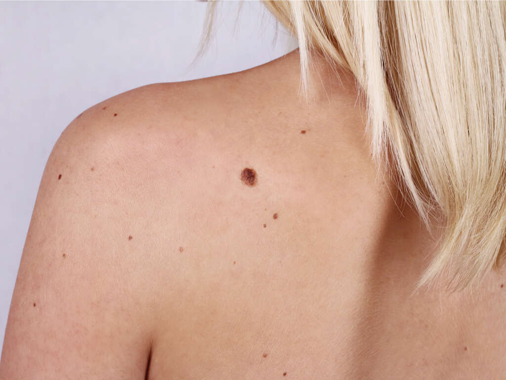What Causes Moles?