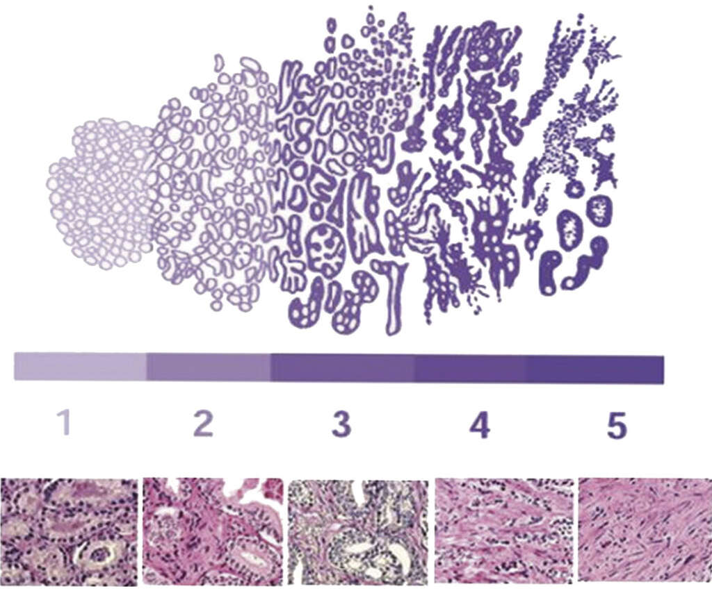 Prostate Cancer