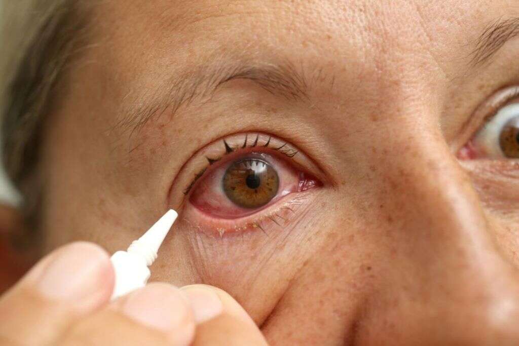 red-eyes-what-causes-red-eyes