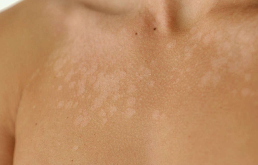 White Spots On Skin