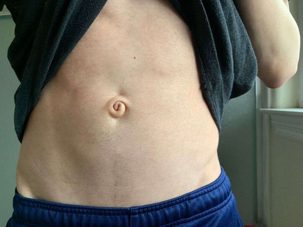 What Is a Belly Button Infection?
