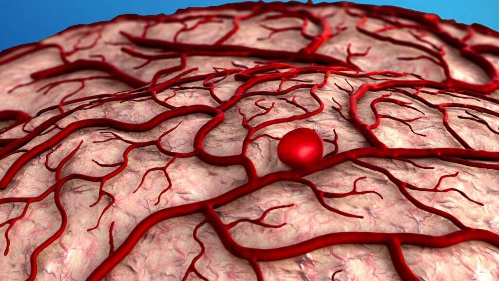 Brain Aneurysm: What Is a Brain Aneurysm?