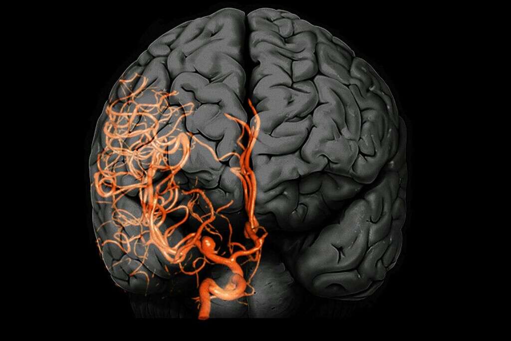 Brain Aneurysm What Is A Brain Aneurysm 