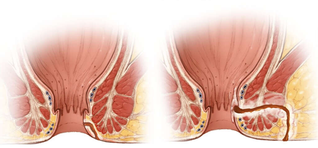 Fistula