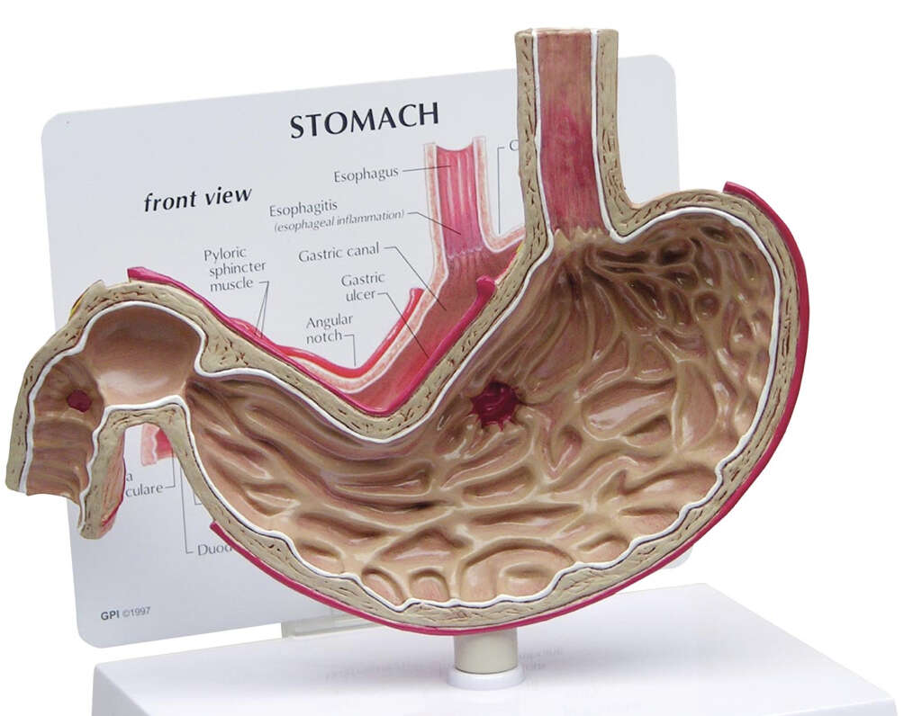 Gastric Ulcer What Is a Gastric Ulcer 