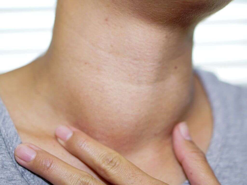 What Does It Mean If You Have A Goiter On Your Thyroid