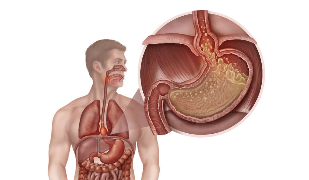 Hiatal Hernia What Is A Hiatal Hernia 