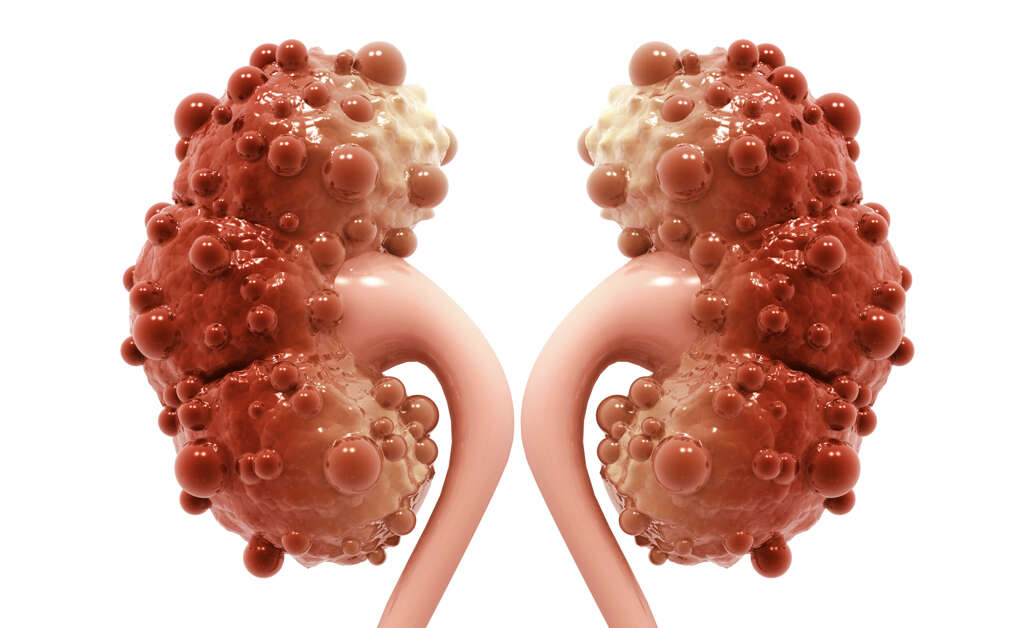 Kidney Cyst