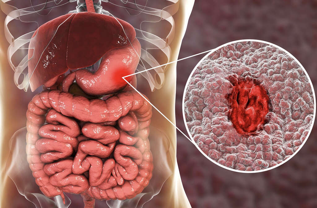 Peptic Ulcer