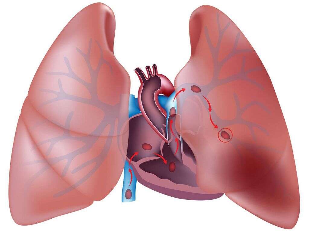 Pulmonary Embolism