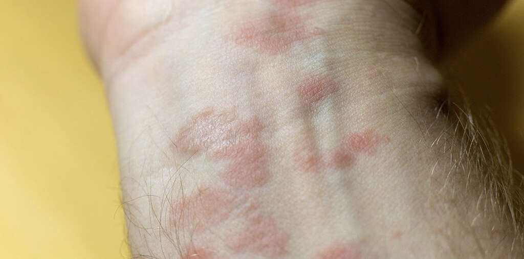 Scabies Rash