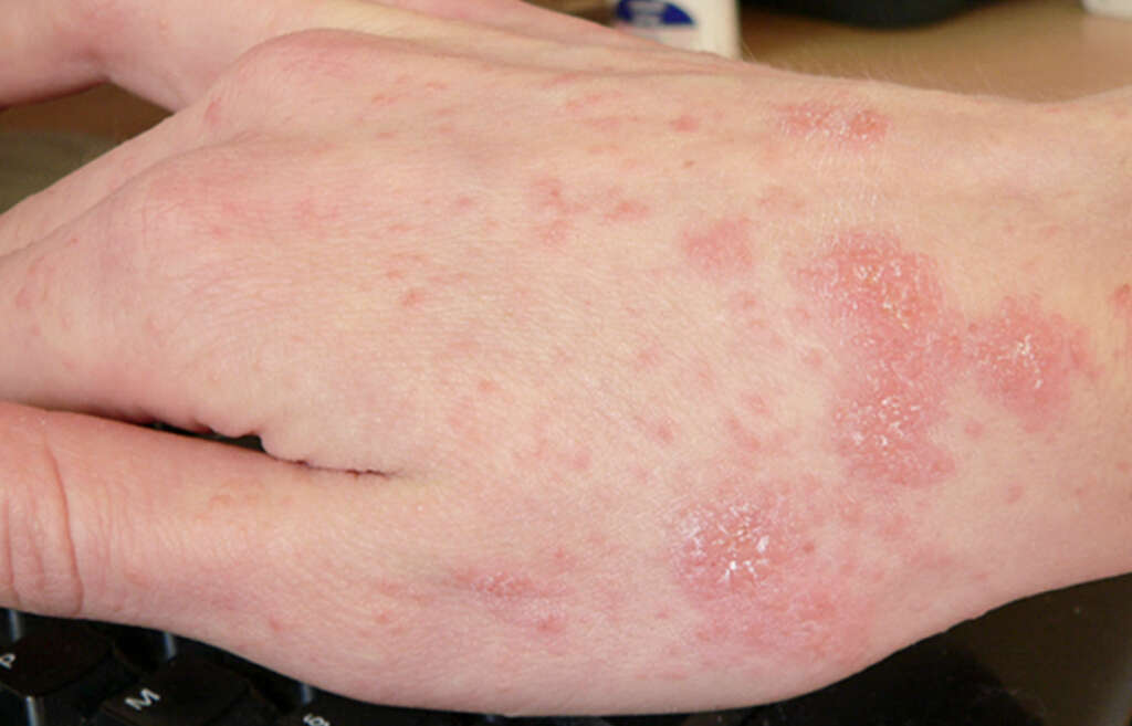 Scabies Rash What Is A Scabies Rash 