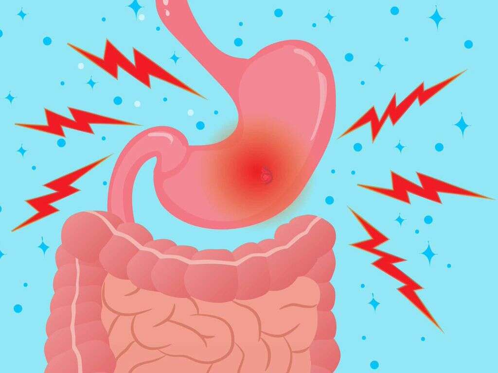 What Is a Stress Ulcer?