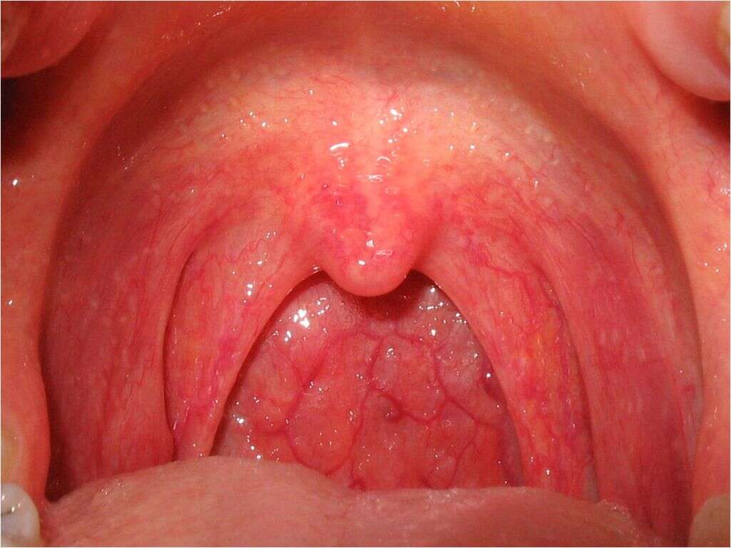 Acute Pharyngitis