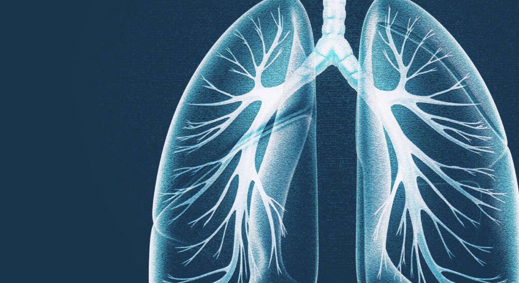 Acute Respiratory Distress Syndrome: What Is Acute ...