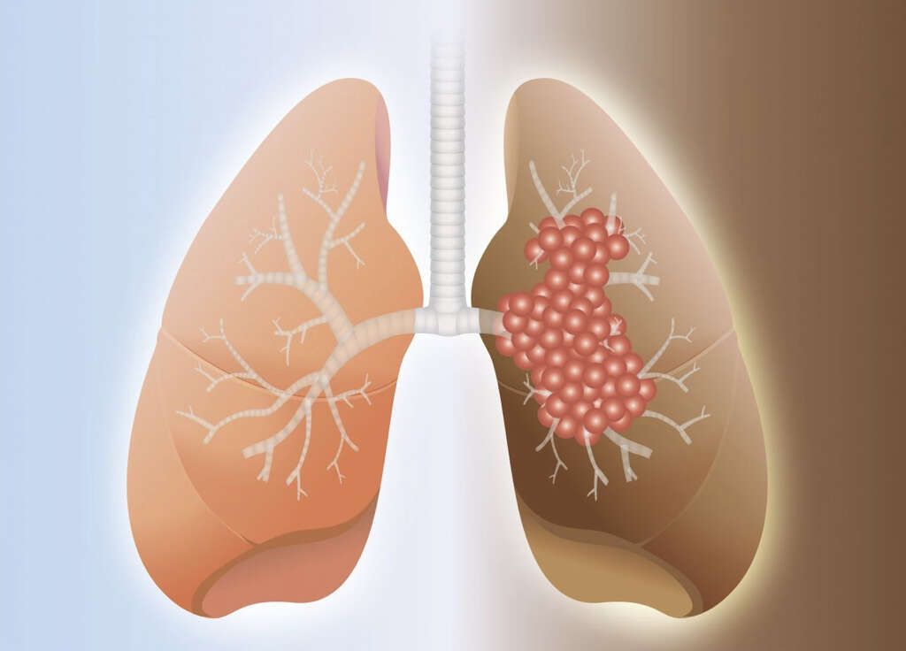 Acute Respiratory Distress Syndrome What Is Acute Respiratory Distress 