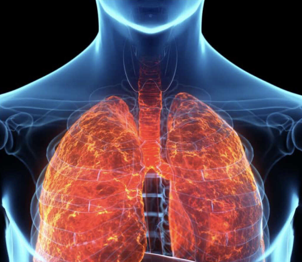 Acute Respiratory Failure What Is Acute Respiratory Failure 