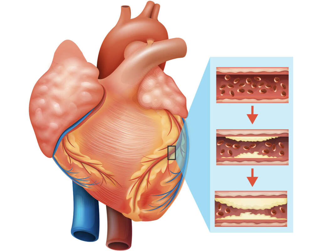 AFib