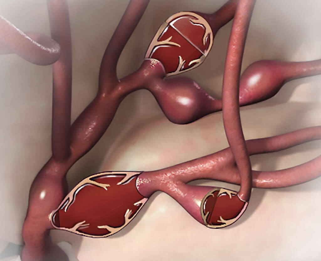 Aortic Aneurysm