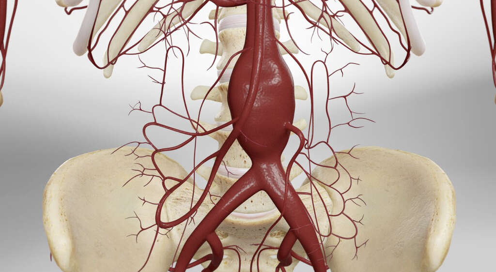 Aortic Aneurysm