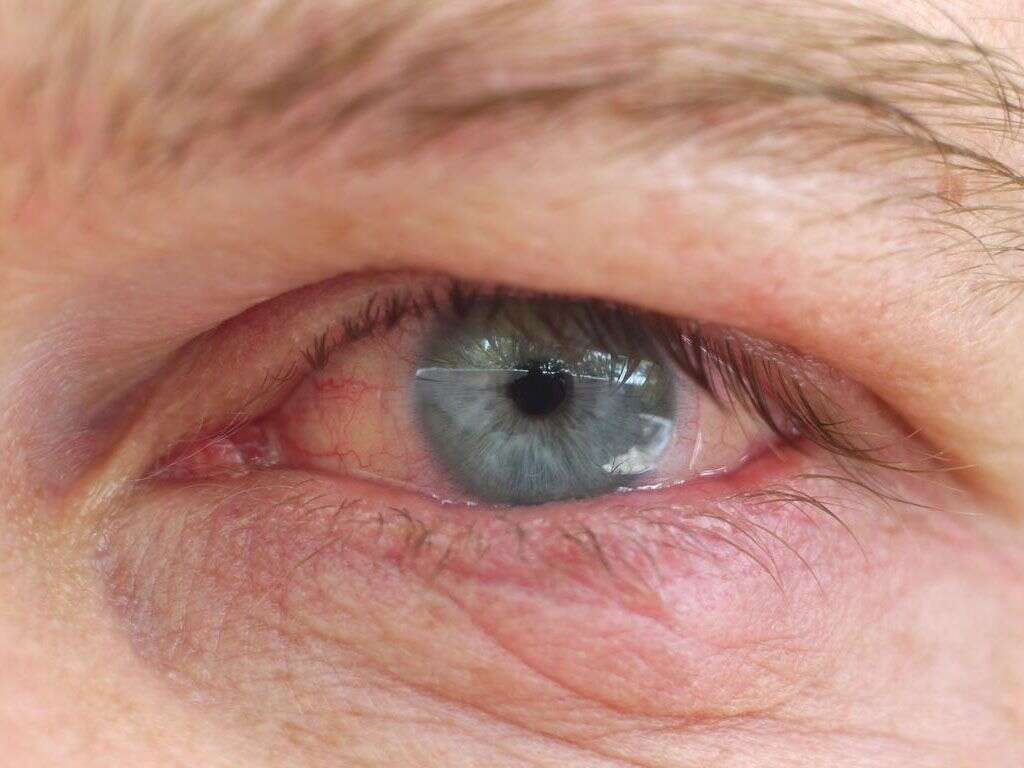 Ulcer On Eye