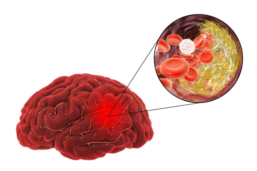 Ischemic Stroke What Is An Ischemic Stroke 