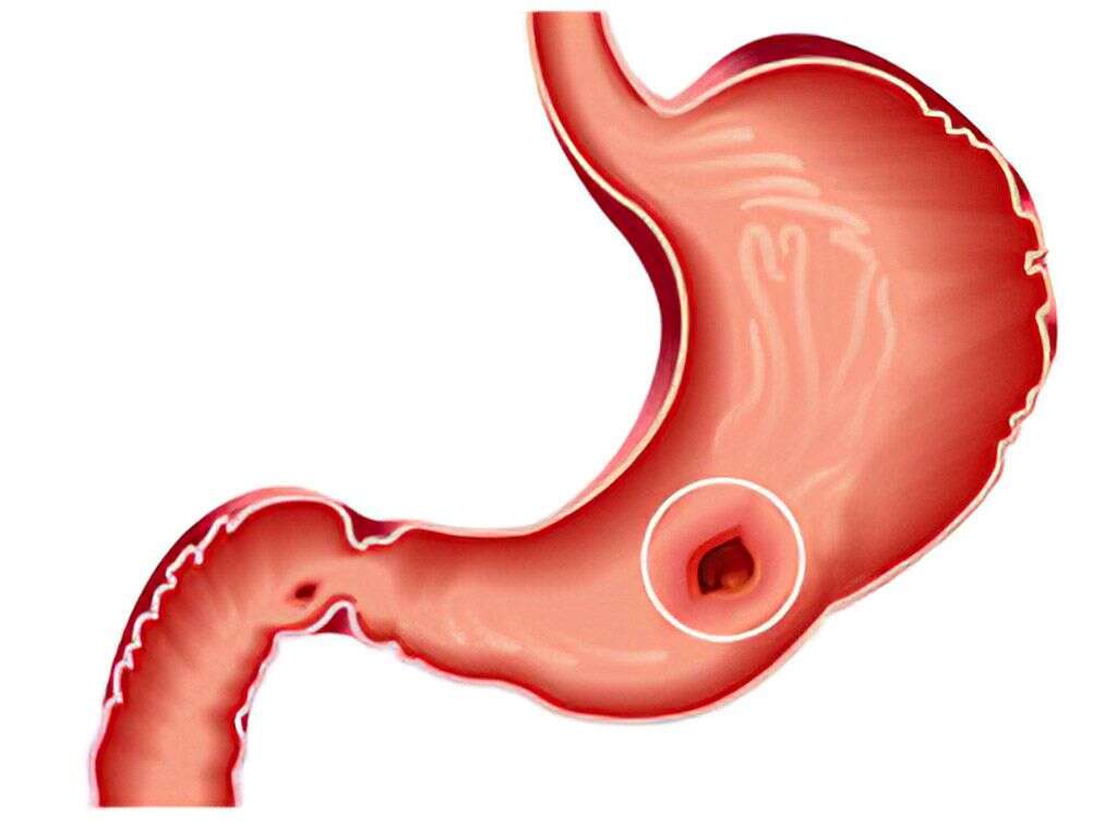 Stomach Ulcer What Is A Stomach Ulcer 