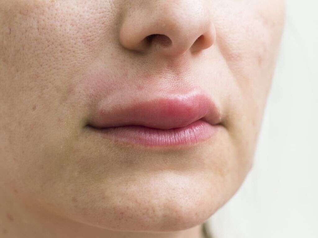 Angioedema 10 Symptoms Of Angioedema