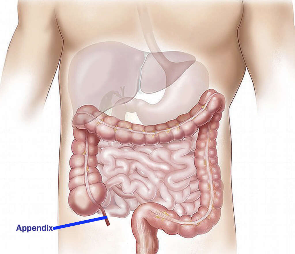 Appendicitis