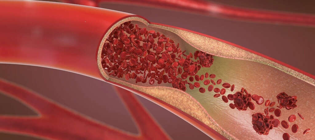 Atherosclerosis