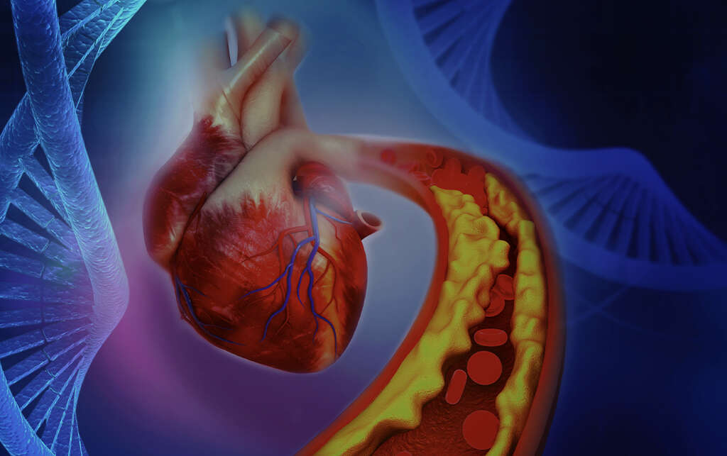 What Is Atherosclerotic Heart Disease