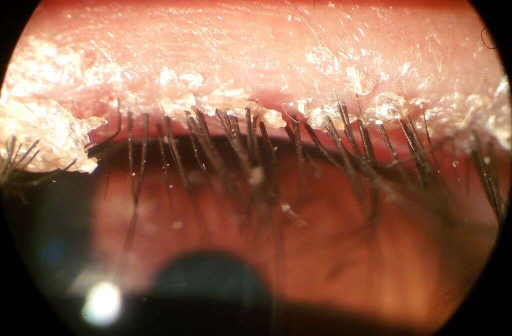 Blepharitis