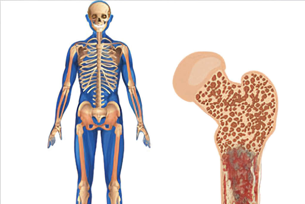Bone Cancer: What Is Bone Cancer?
