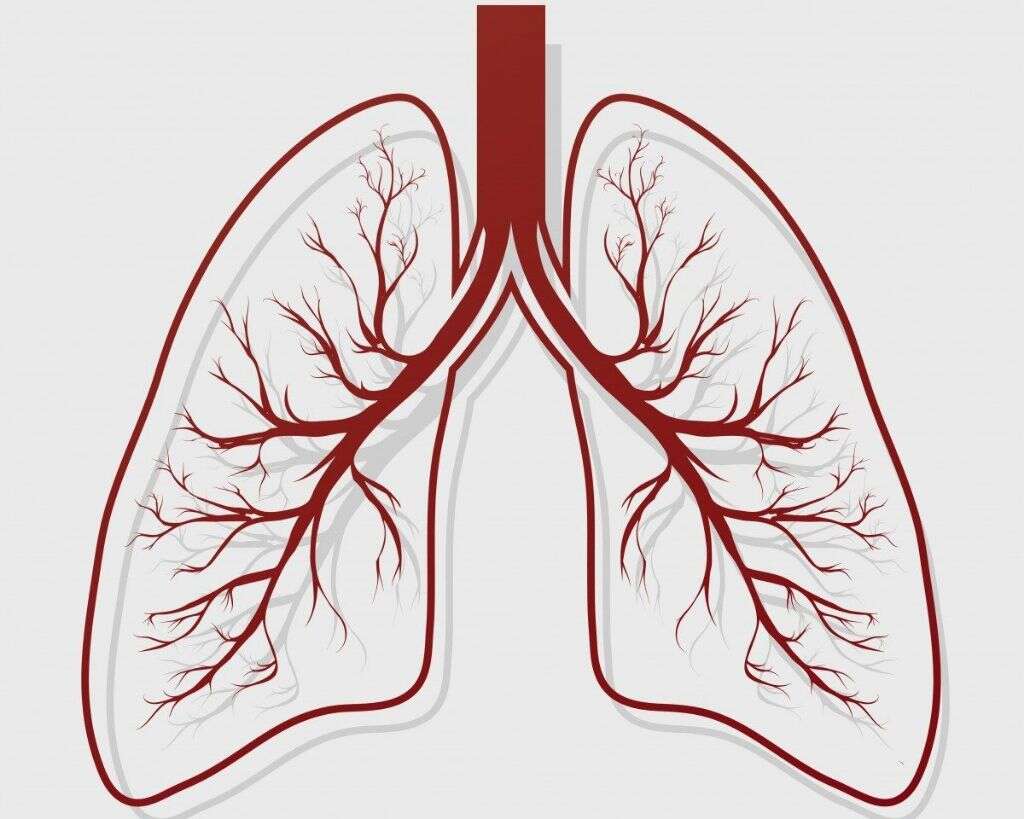 Bronchiectasis