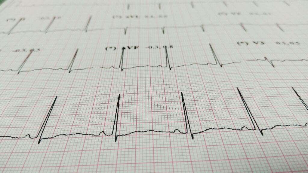 Brugada Syndrome