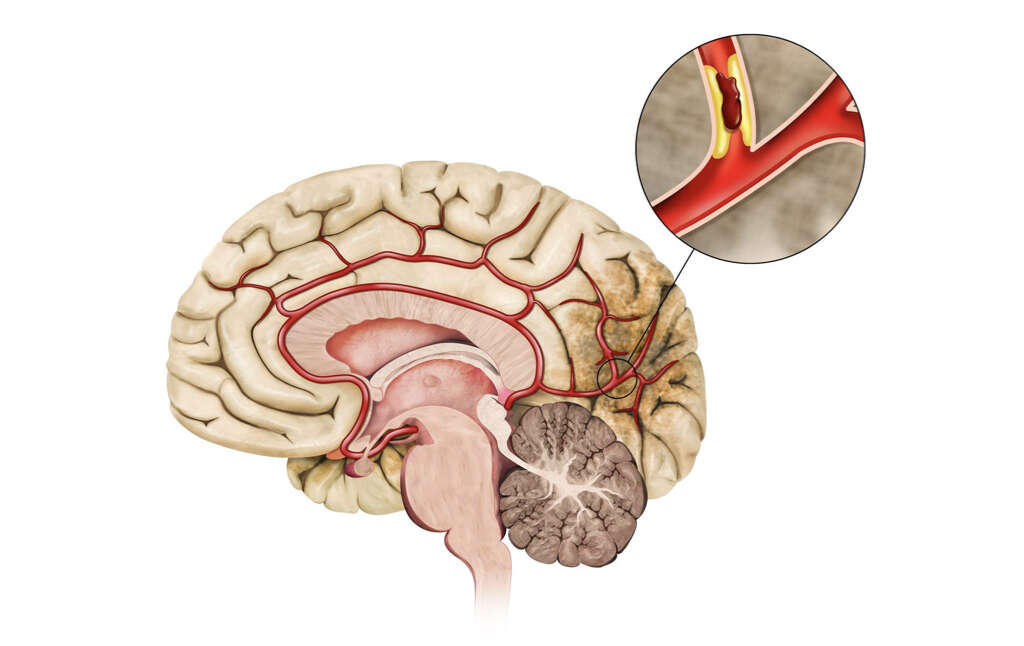 cerebral-infarction-what-is-cerebral-infarction