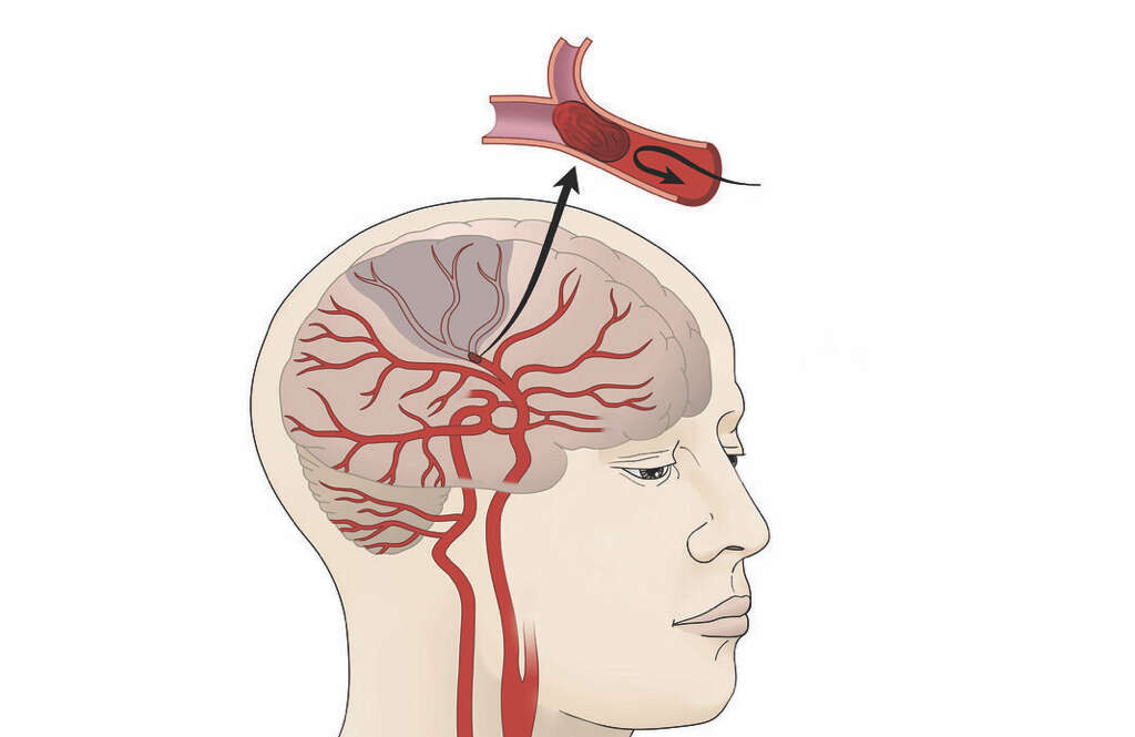 Cerebral Infarction