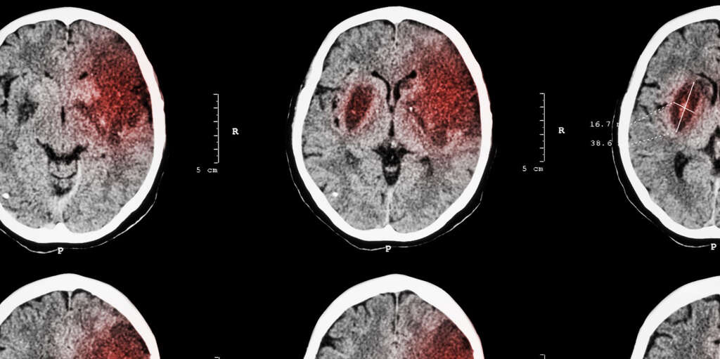 cerebral-infarction-what-is-cerebral-infarction