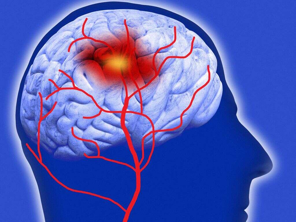 What Are Examples Of Cerebrovascular Accident