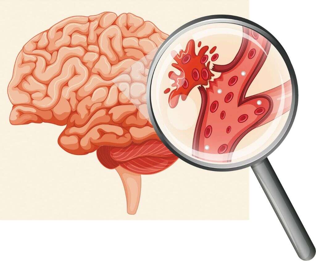 cerebrovascular-accident-stroke-nursing-care-and-management-a-study