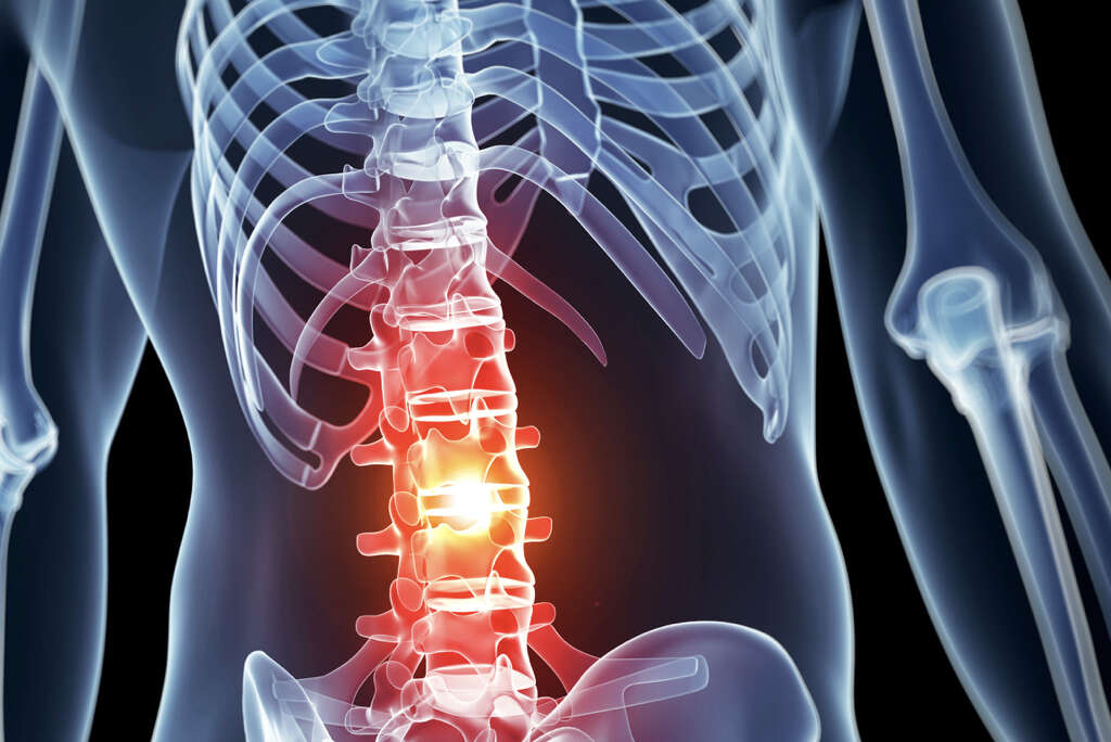 Cervical Stenosis