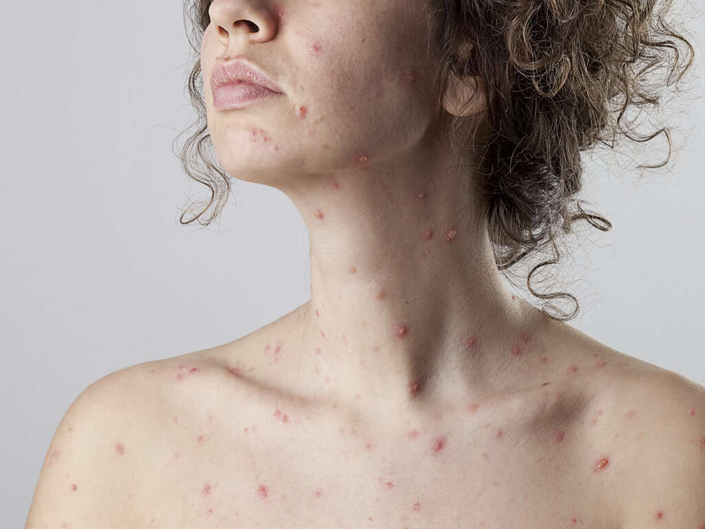 What Is Chicken Pox?
