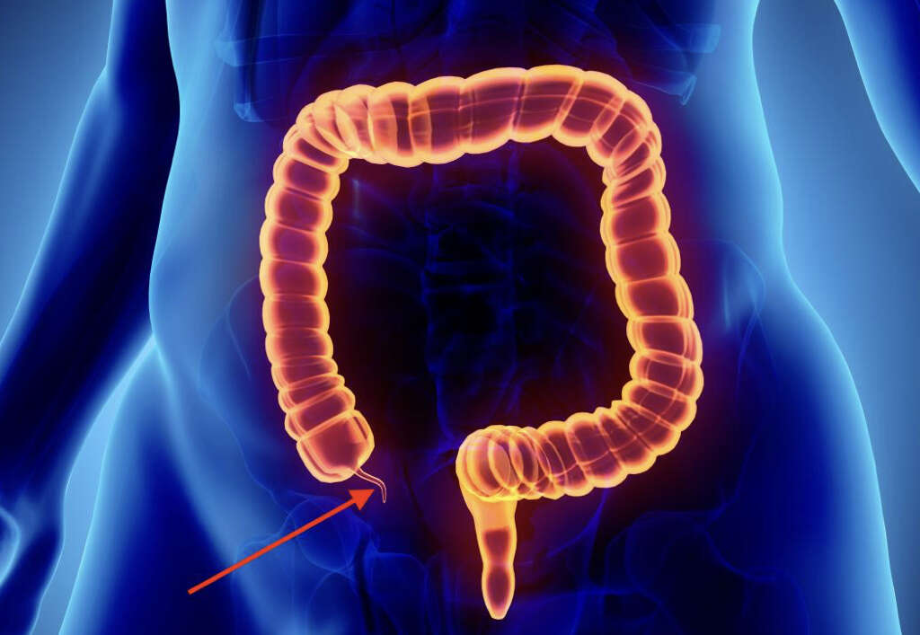 Chronic Appendicitis