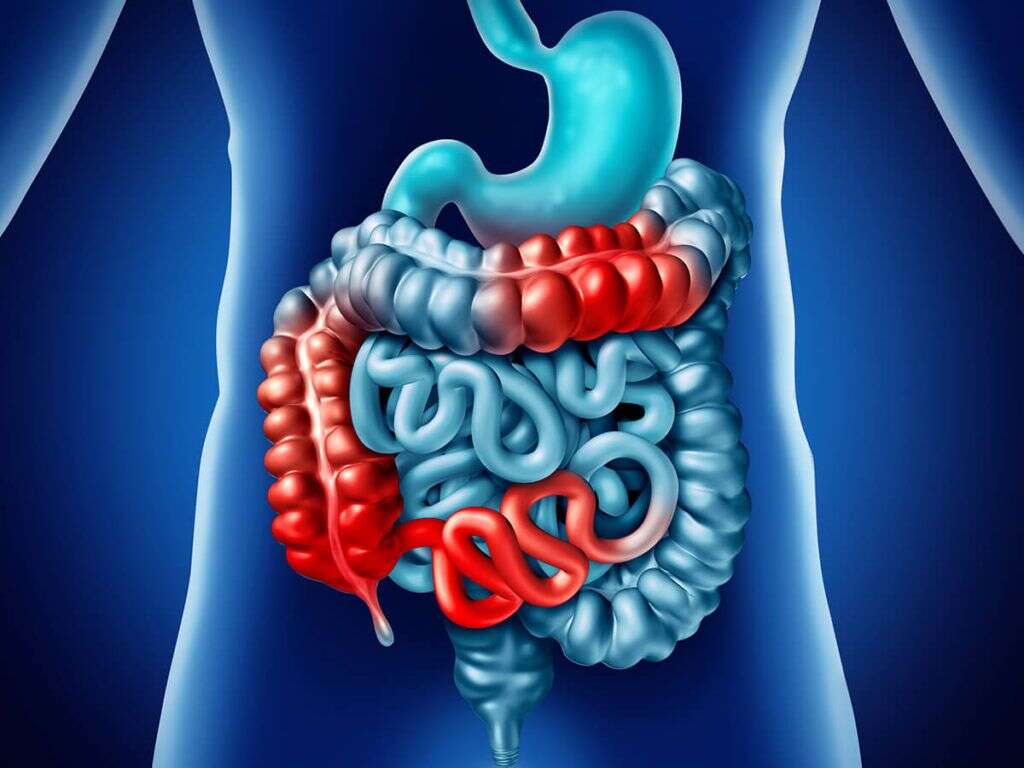 Colitis