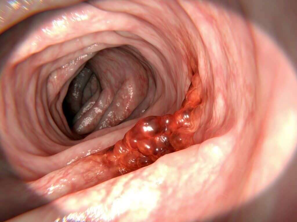 Colon Cancer