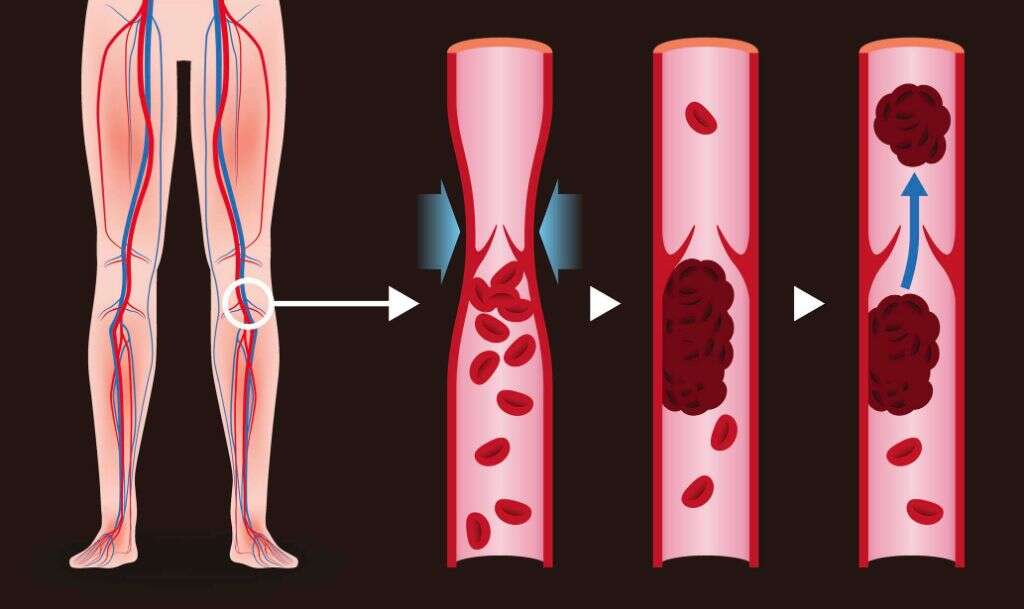 Deep Vein Thrombosis