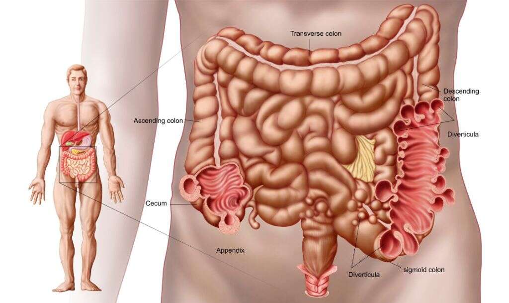 Diverticulosis