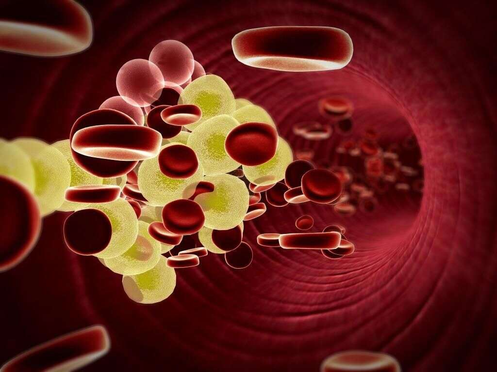 Dyslipidemia