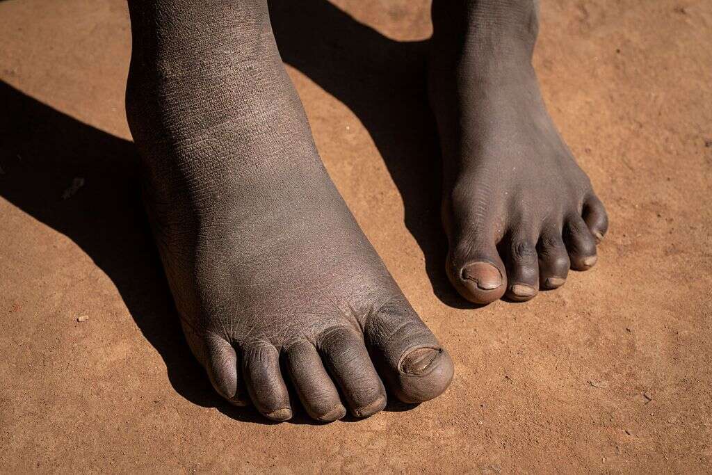 Elephantiasis What Is Elephantiasis 