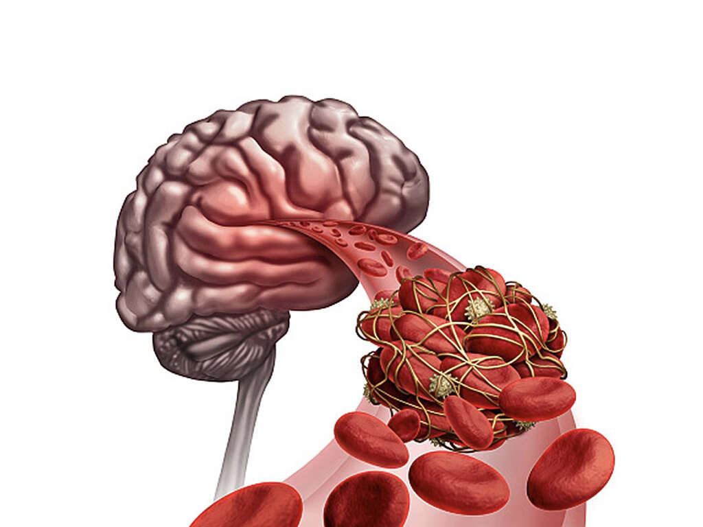 What Is Embolic Stroke?